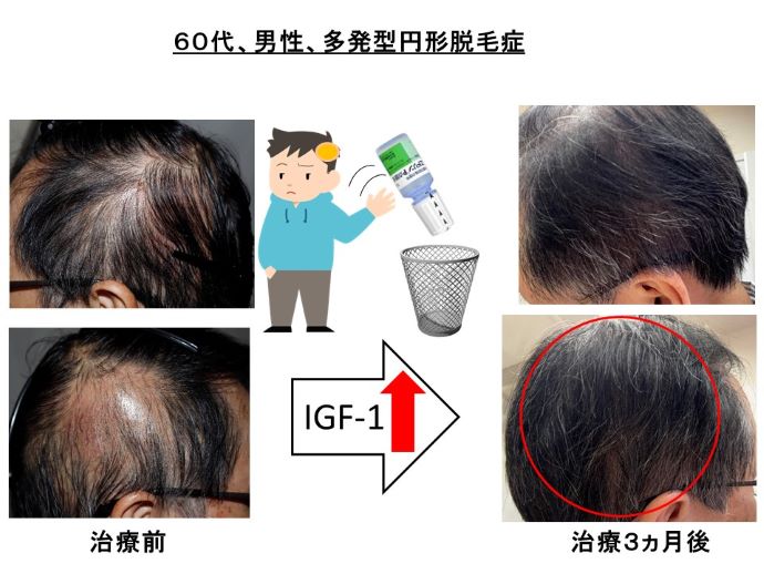円形脱毛症　病院